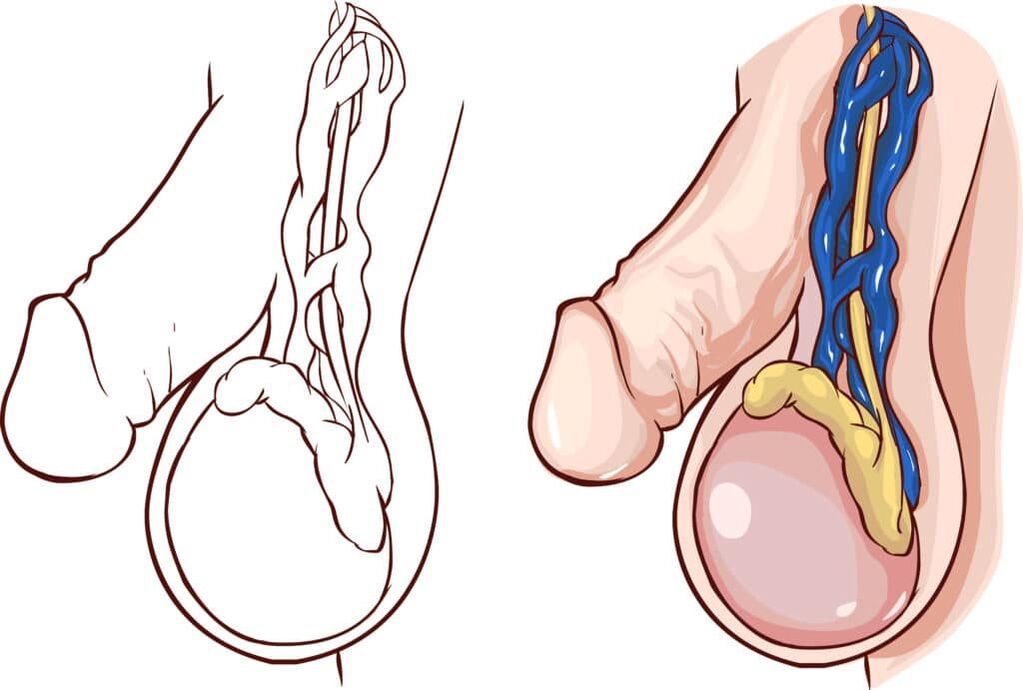 varicocele as a cause of pain in the eggs when aroused